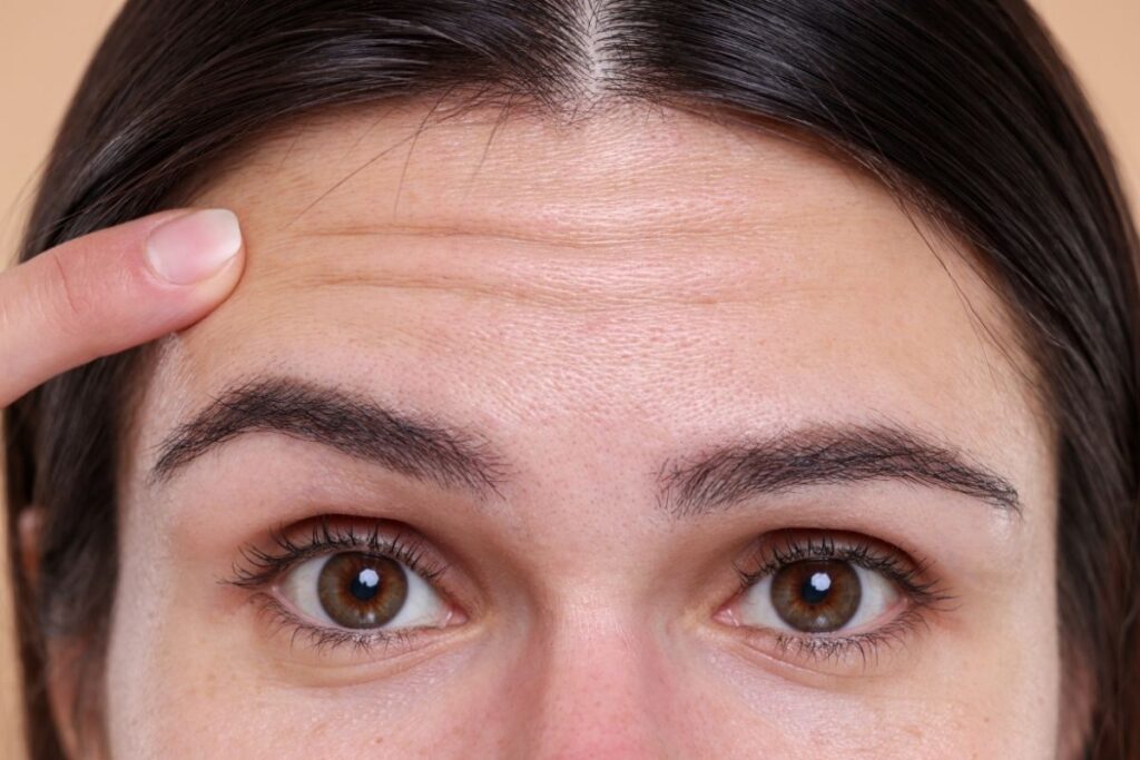 Botox preventivo